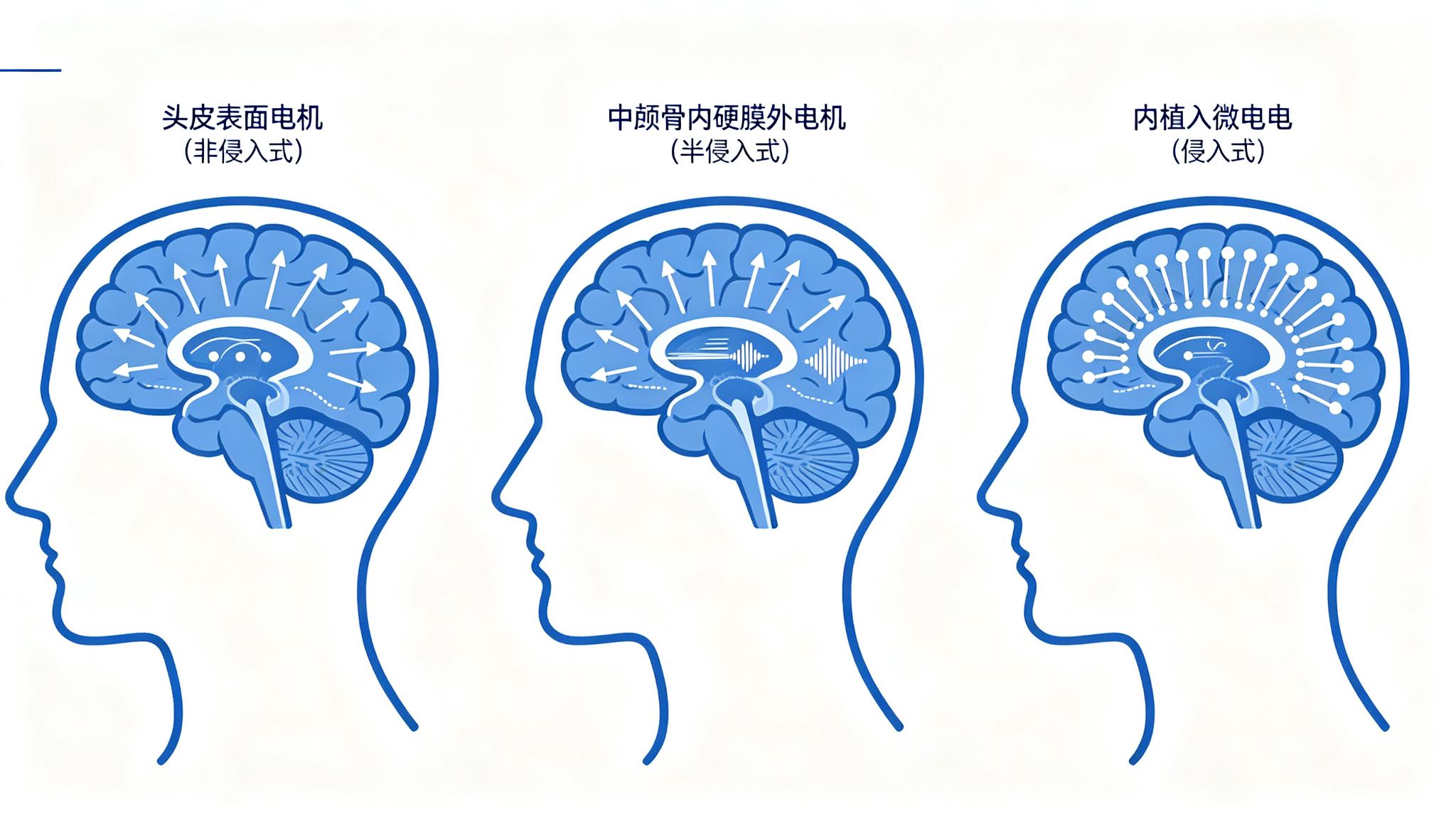脑机接口三种技术路线对比